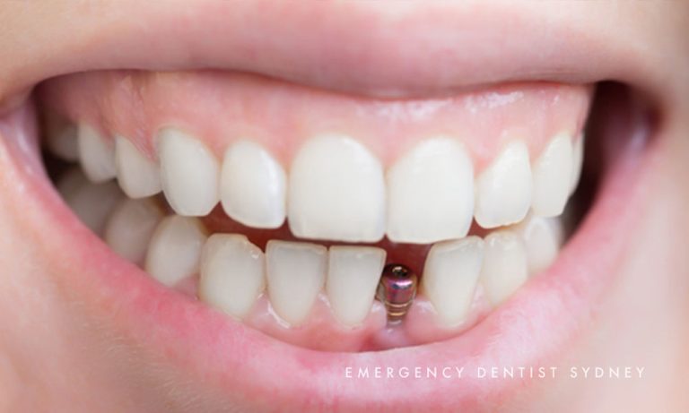 Necessary Things to Remember After Getting Dental Implants